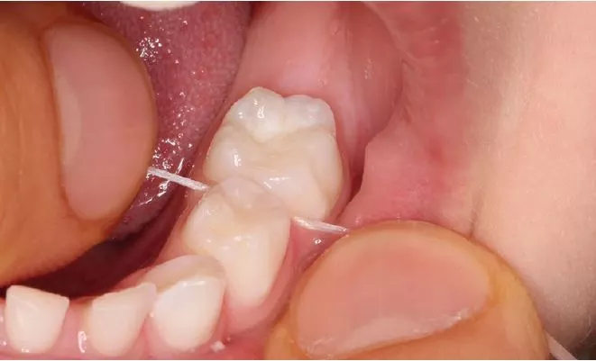 Abb. 8: Reinigung der Interdentalräume bei einem 5-jährigen Kind mit Zahnseide durch ein Elternteil. Auch wenn die Frontzähne sehr lückig stehen, ist der Interdentalraum zwischen den Milchmolaren oder später zwischen zweitem Milchmolar und erstem bleibenden Molar oft sehr eng, sodass die Reinigung mit Zwischenraumbürsten nicht möglich ist.