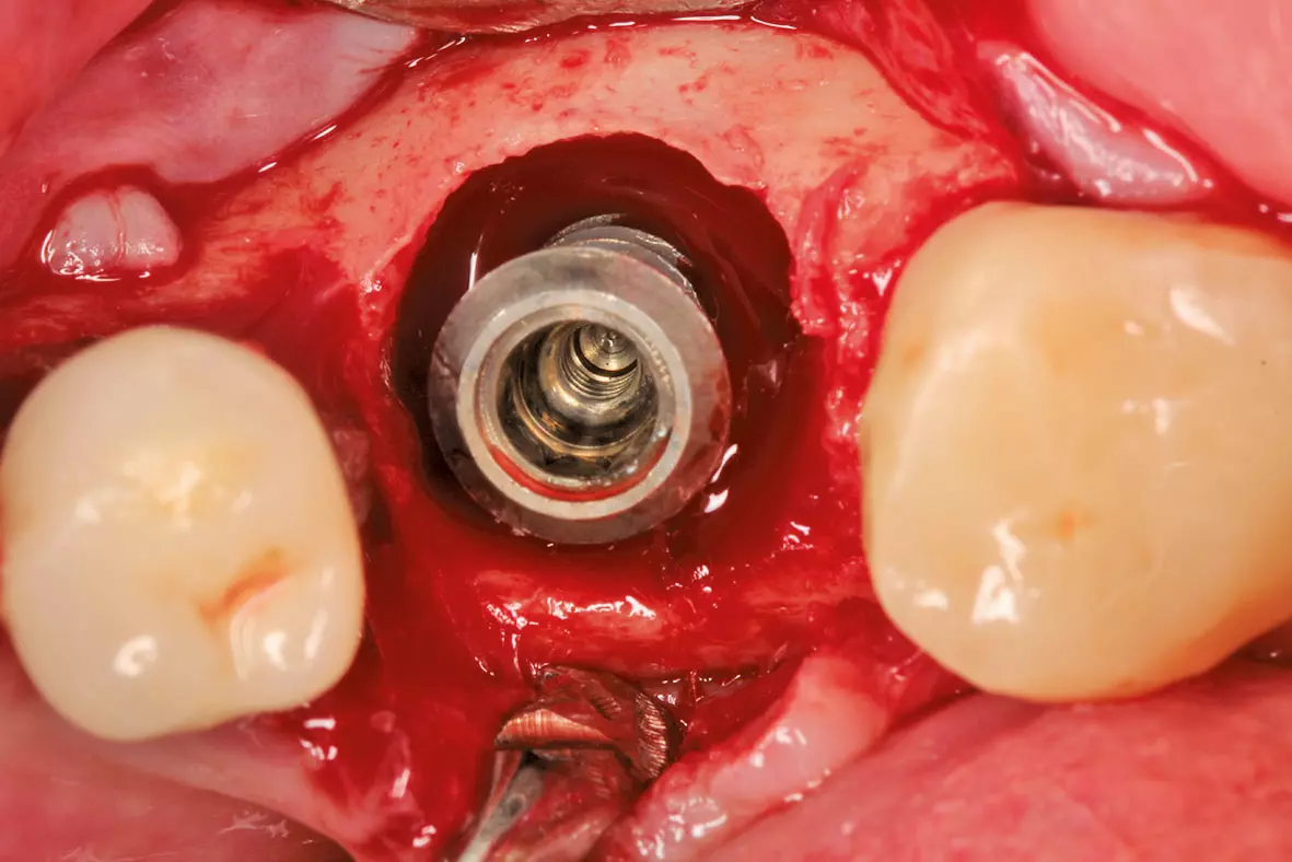 Abb. 1 und 2: Eingeschränkter Zugang an den Gewindeunterseiten der Implantate.