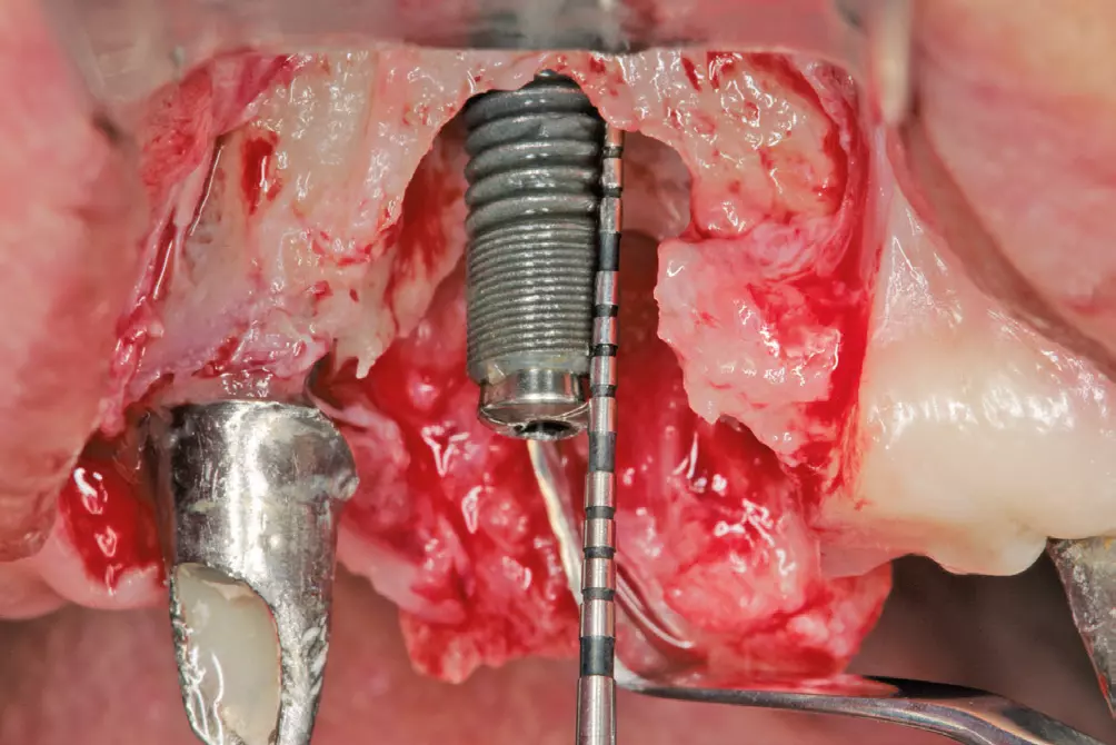 Abb. 1 und 2: Eingeschränkter Zugang an den Gewindeunterseiten der Implantate.