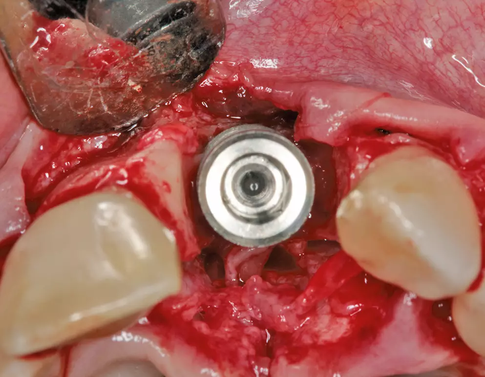 Abb. 8: Großer Implantatdurchmesser.