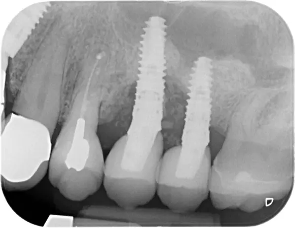 Abb. 9 a bis e: Auch Defekte mit einer primär schlechten Prognose bezüglich der periimplantären Regeneration können regeneriert werden.