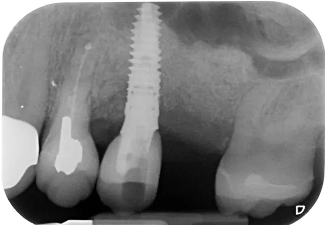 Abb. 9 a bis e: Auch Defekte mit einer primär schlechten Prognose bezüglich der periimplantären Regeneration können regeneriert werden.