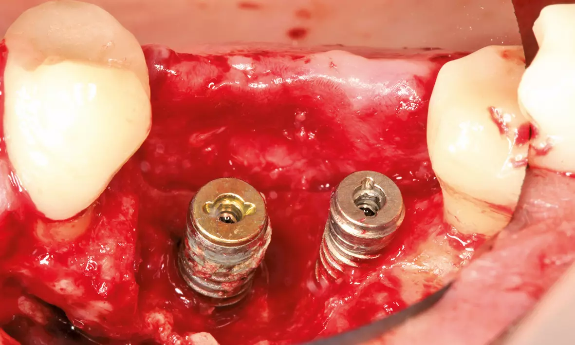 Abb. 9 a bis e: Auch Defekte mit einer primär schlechten Prognose bezüglich der periimplantären Regeneration können regeneriert werden.