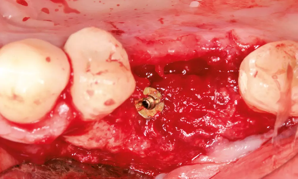 Abb. 9 a bis e: Auch Defekte mit einer primär schlechten Prognose bezüglich der periimplantären Regeneration können regeneriert werden.