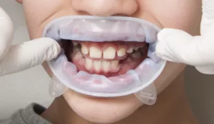 Abb. 1: Einsetzen eines flexiblen Lippen-Wangen-Halters.