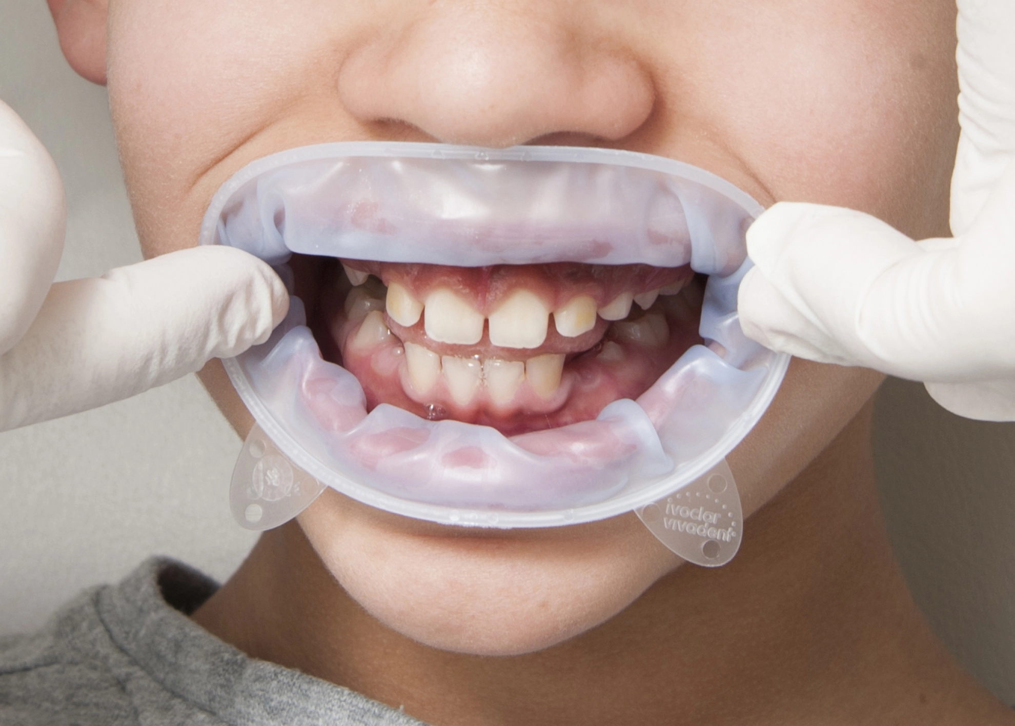 Abb. 1: Einsetzen eines flexiblen Lippen-Wangen-Halters.