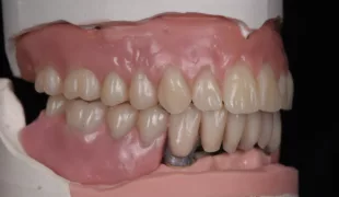 Abb. 1: Die Aufstellung auf dem implantatgetragenen Gerüst im Unterkiefer soll in Komposit übertragen werden.
