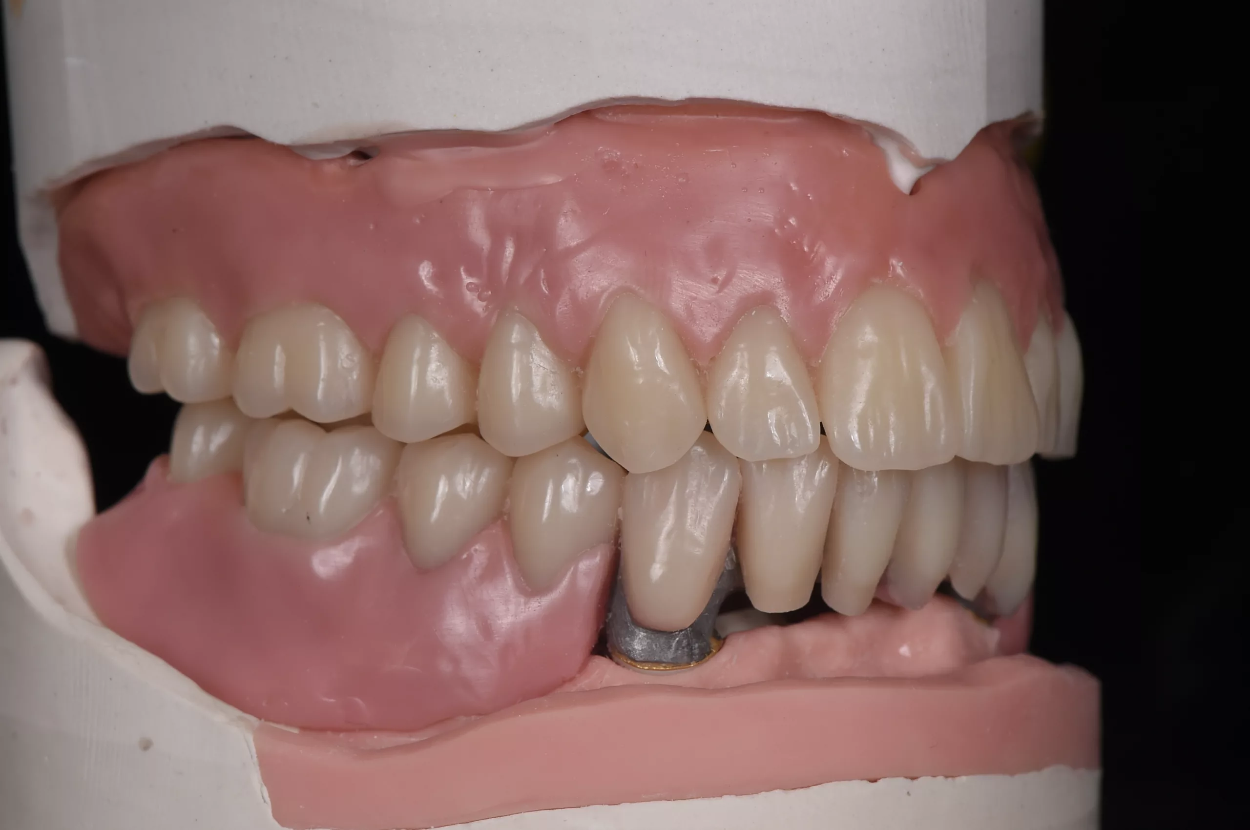 Abb. 1: Die Aufstellung auf dem implantatgetragenen Gerüst im Unterkiefer soll in Komposit übertragen werden.