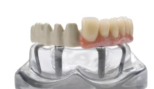 JUVORA™ Dental Disc Implantat-Prothetikgerüst.