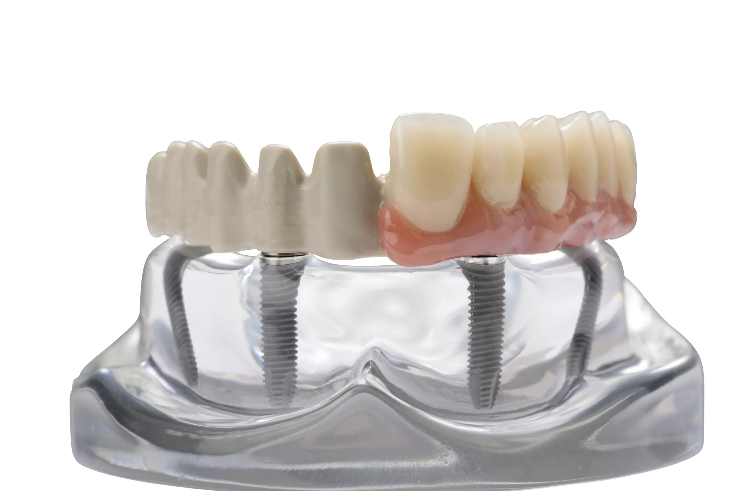 JUVORA™ Dental Disc Implantat-Prothetikgerüst.