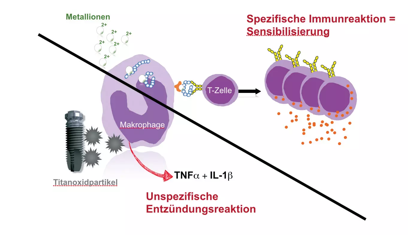 Abb. 1: Unterschiedliche Pathomechanismen der Makrophagenaktivierung: zum einen über Titanpartikel und zum anderen über an Proteine gebundene Metallionen, die das spezifische Immunsystem (T-Lymphozyten) aktivieren.
