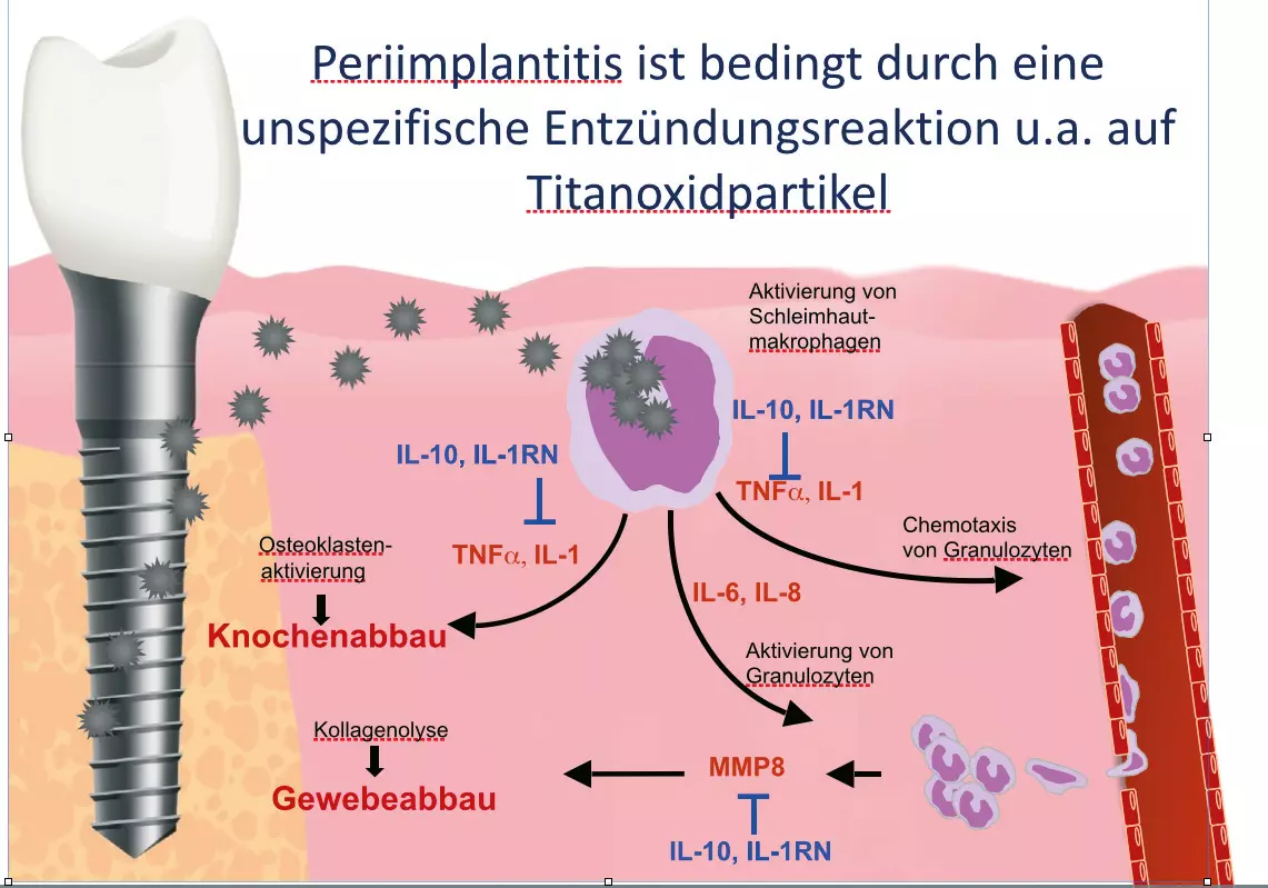 Abb. 2: Immunologischer Pathomechanismus der Mukositis- und Periimplantitisentwicklung.