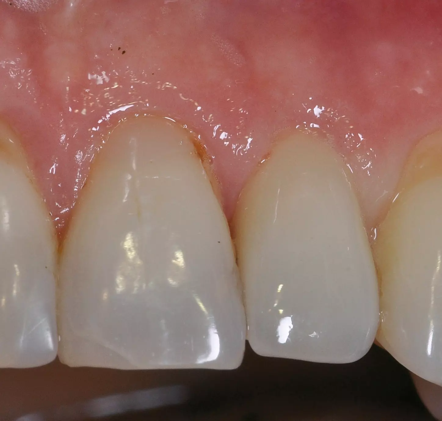 Abb. 7: Zustand nach Eingliederung der E-max-Krone auf Implantat 22.