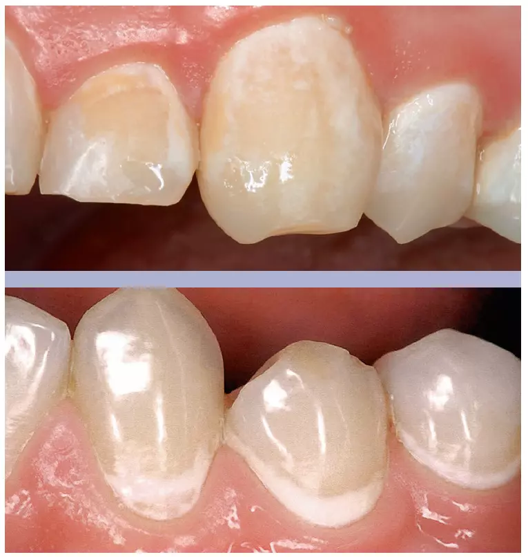 Abb. 5a u. b: Vor einer GBT (oben) können White Spots von Biofilm verborgen sein, nach der Reinigung sind sie gut erkennbar.