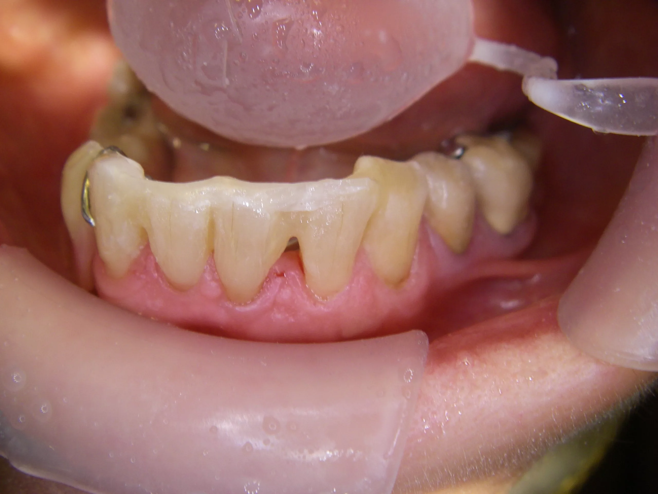 Da das Schienmaterial mit einem cremigen Kunstharz getränkt ist, kann es ohne Vorbereitung und Tropfgefahr direkt adaptiert werden.