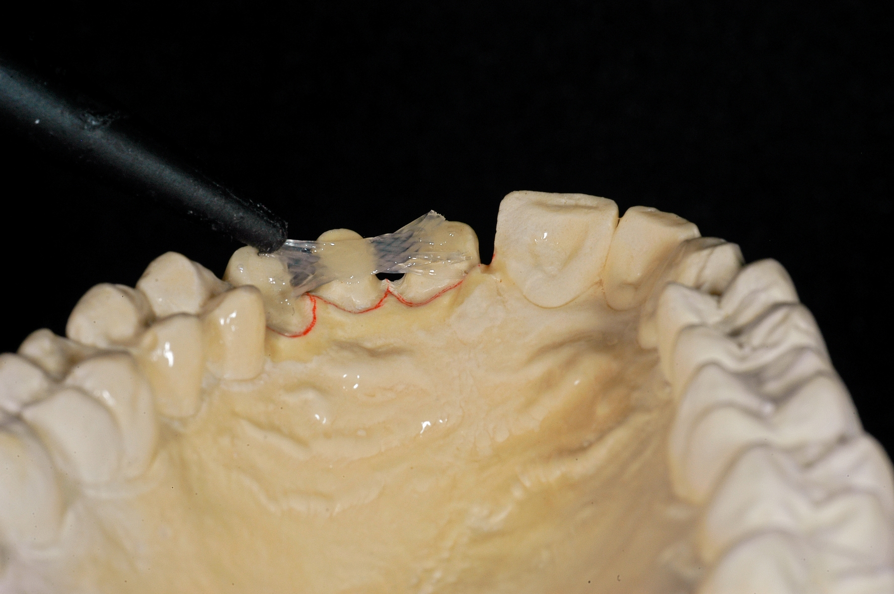 Insbesondere wenn im Laufe einer geplanten Behandlung die Schienung eines lockeren Zahnes notwendig wird, braucht der Arzt ein flexibel einsetzbares Universalmaterial, sodass er auch kurzfristig reagieren kann.