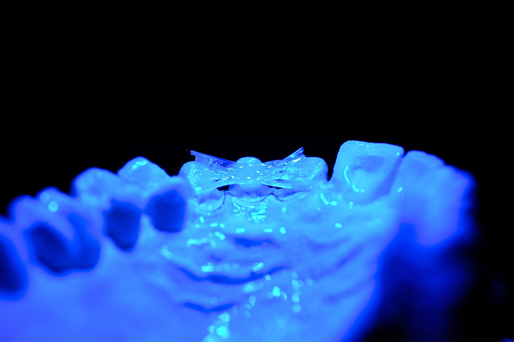 Nach dem Auftragen wird für 30 bis 60 s lichtgehärtet und durch die Polymerisation eine stabile Form erzeugt.