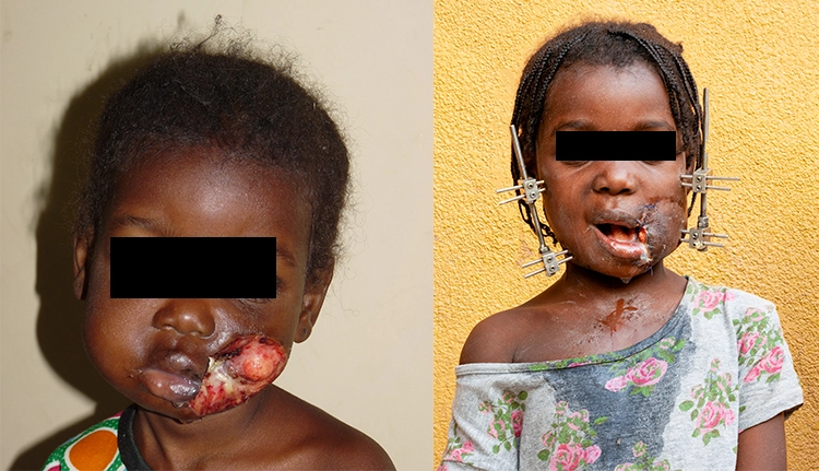 Links: Ausgangsbild. Rechts: Bild nach der OP und weiterer Therapie.