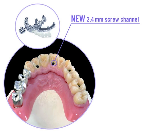 cara I-Bridge® X – das Original jetzt mit 2,4 mm Schraubenkanal und bis zu 30° Abwinklung.