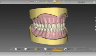 Die inLab SW 20.0 führt Schritt für Schritt durch das digitale Prothesendesign – einfach, schnell und sicher.