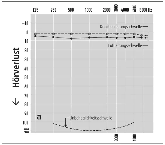 Abb. 1: Tonaudiogramm.