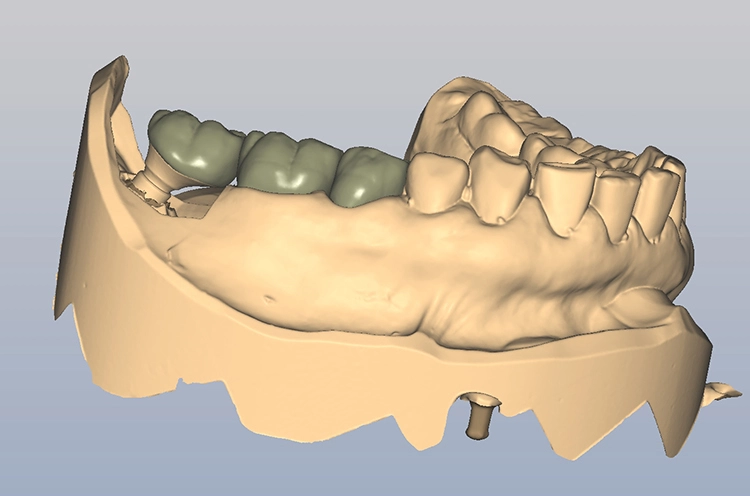 Abb. 11: Modellscans: d) Vestibuläre Ansicht.