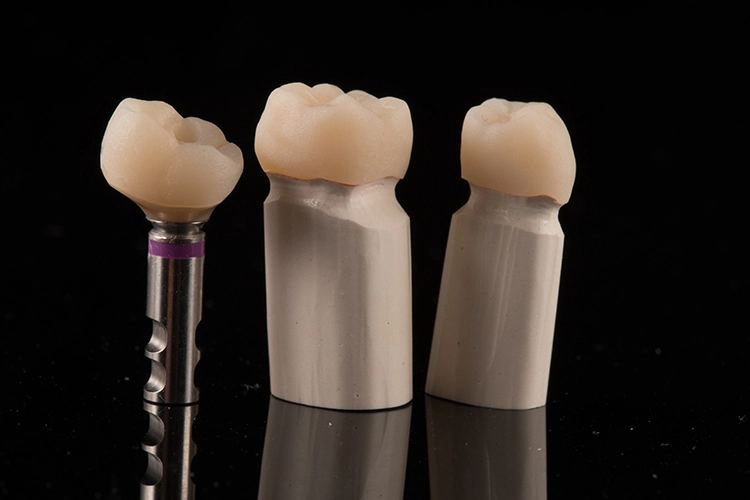 Abb. 14: Überprüfung der Randpassung im Bereich der Stümpfe und dem Implantataufbau.