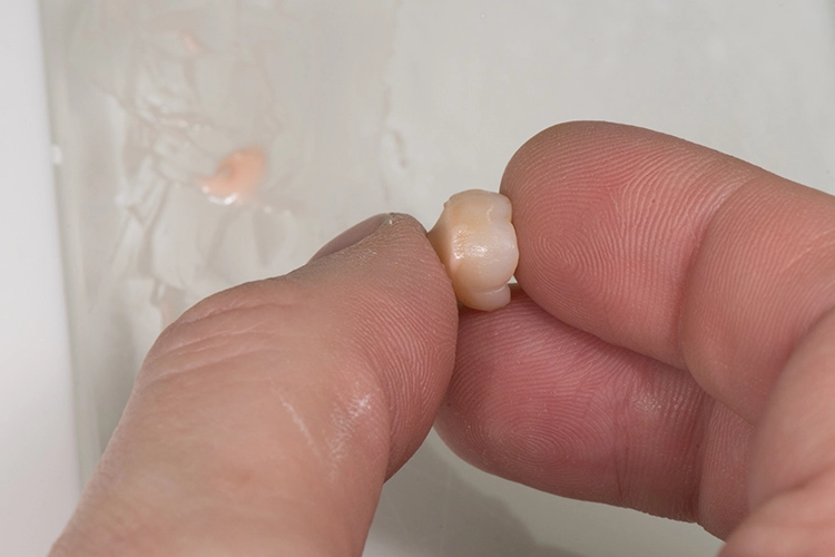 Abb. 16d: Die Lithium-Disilikat-Krone wurde auf das individuell angepasste Zirkonoxid-Abutment gelötet.