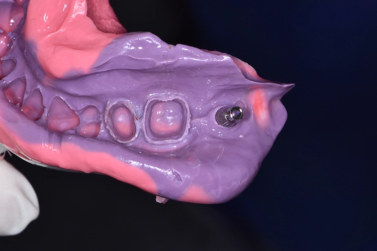 Abb. 8: Einschritt-Doppelmischabformung, kombiniert mit Pick-up des Implantats.