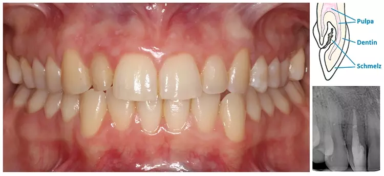 links: Ausgangszustand, konservativ suffizient versorgtes Gebiss mit einem Dens invaginatus 12; rechts oben: Schematische Darstellung eines Dens in dente, Zahnbildungsstörung mit Schmelzeinstülpung im Bereich der Zahnkrone; rechts unten: Zahnfilm 12: homogene, dichte, bis zur röntgenologischen Konstriktion reichendende Verschattung im Sinne einer Wurzelfüllung.