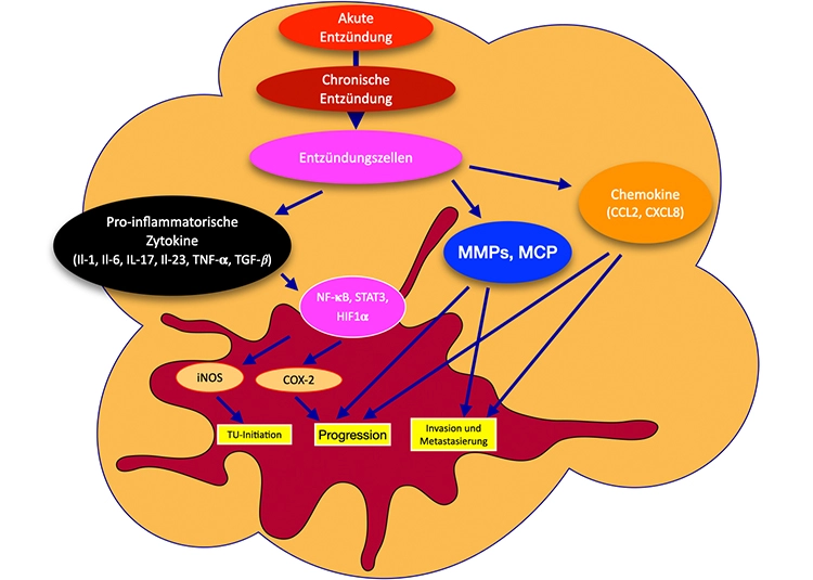 Abb. 3: Einfluss von Zytokinen, Chemokinen und Proteasen auf die Tumorentstehung,
Progression und Metastasierung. (Modifiziert nach Chakraborty et al.,
2020 [16]).
IL-1, -6, -17, -23 = proinflammatorische Zytokine, TNF-? = Tumor-Nekrose-Faktor
alpha, TGF-? = transforming growth factor beta, NF-?B = Transkriptionsfaktor,
STAT3 = signal transducer and activator of transcription 3, HIF1? = hypoxiainducible
factor-1?, iNOS= inducible Nitric Oxide Synthase.