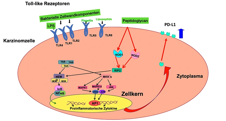 Abb. 6: Zusammenhänge zwischen bakteriellen Molekülen und den zellulären Rezeptoren, die in Tumorzellen zur Hochregulation des immunsupprimierenden
Rezeptors (PD-L1) führen. Im Gegensatz zu anderen bakteriellen Komponenten (z.B. LPS) wird das Peptidoglycan in die Tumorzelle aufgenommen und bindet
intrazellulär an die dort vorhandenen intrazellulären Toll-like-Rezeptoren NOD-1 und NOD-2. Von da aus wandert das Signal über verschiedene Zwischenstufen in den
Zellkern und führt zur mRNA-Hochregulation und anschließenden Proteinproduktion neuer PD-L1-Rezeptoren, die nach ca. 24 Stunden auf der Zelloberfläche
erscheinen.