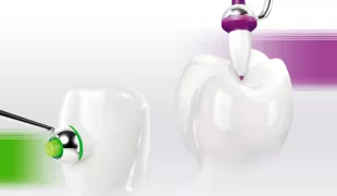 Als Ergänzung zum beliebten OptraSculpt Pad für den Frontzahnbereich ist nun das OptraSculpt® Next Generation für den Seitenzahnbereich erhältlich.