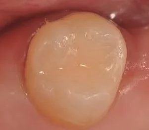 Endsituation mit Tetric EvoCeram Bulk Fill
- Dr. Eduardo Mahn, Chile