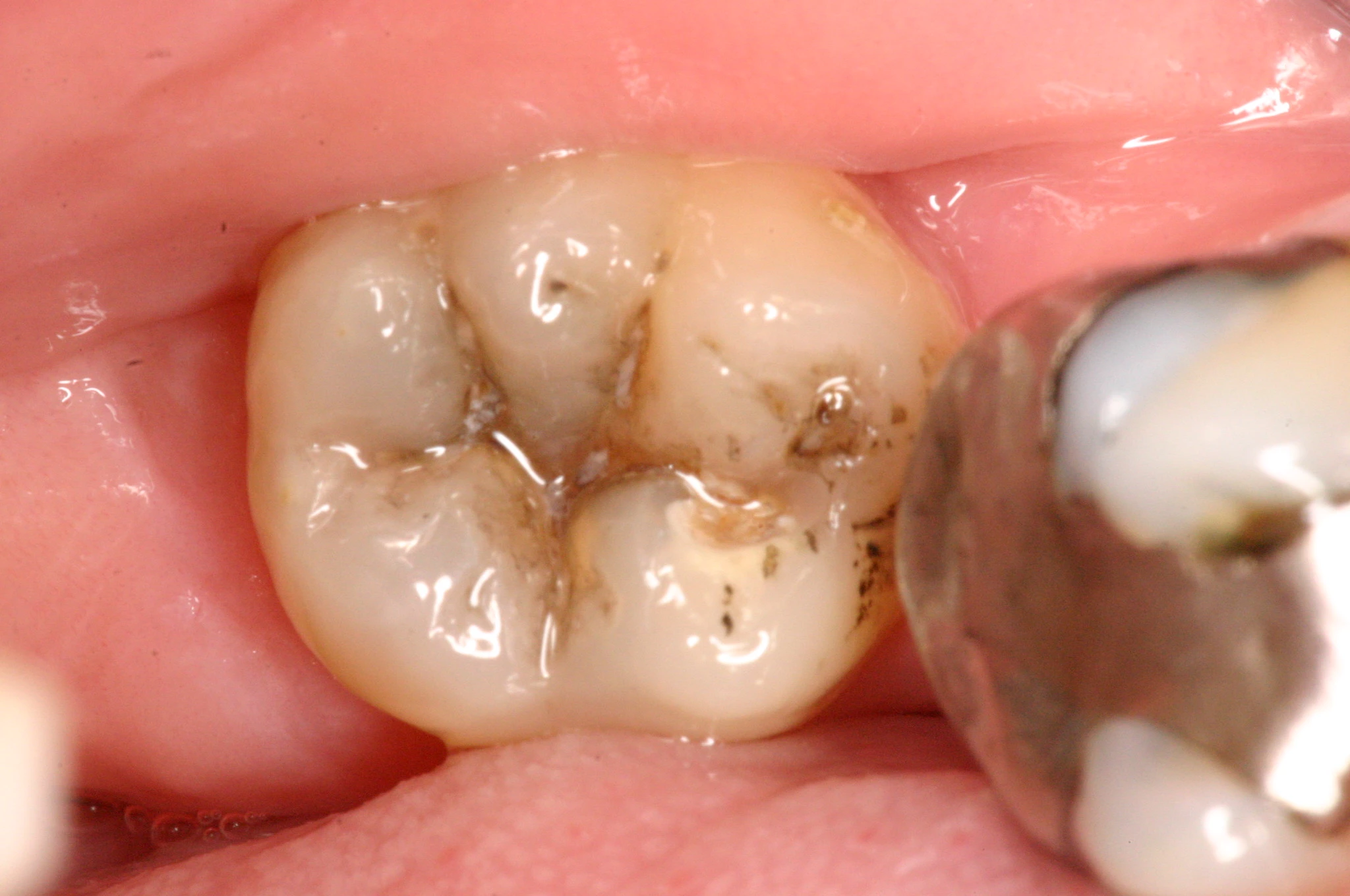Abb. 2: Der dunkle Dentinschatten (ICDAS Code 4) deutet sicher auf eine unterminierende Dentinkaries hin.