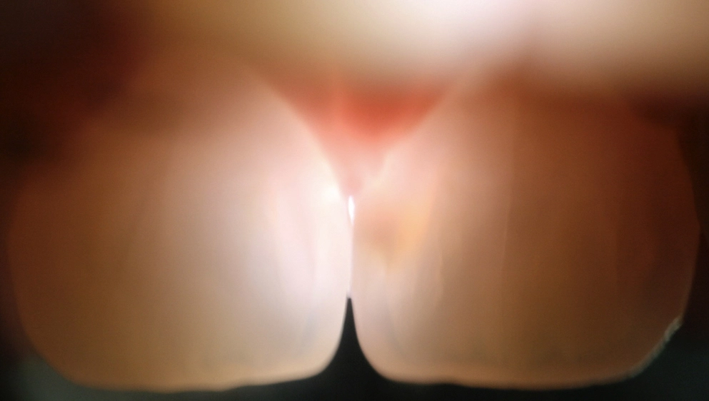 Abb. 5: Die Fiberoptische Transillumination (FOTI) visualisiert
insbesondere in der Front möglicherweise vorhandene Dentinläsionen.