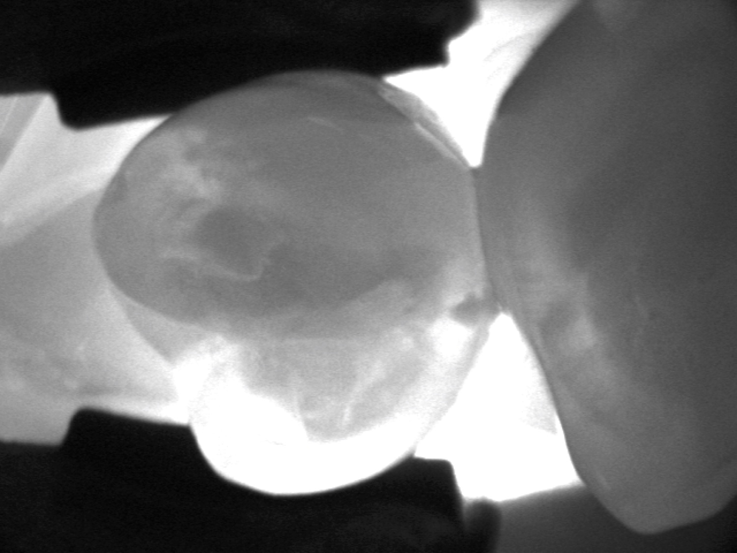 Abb. 6: Die Nahinfrarot-Transillumination (DIAGNOcam, KaVo)
stellt approximale Primärkaries gut dar. Berührt der Schatten das Dentin nicht, reicht die Karies nicht ins Dentin.