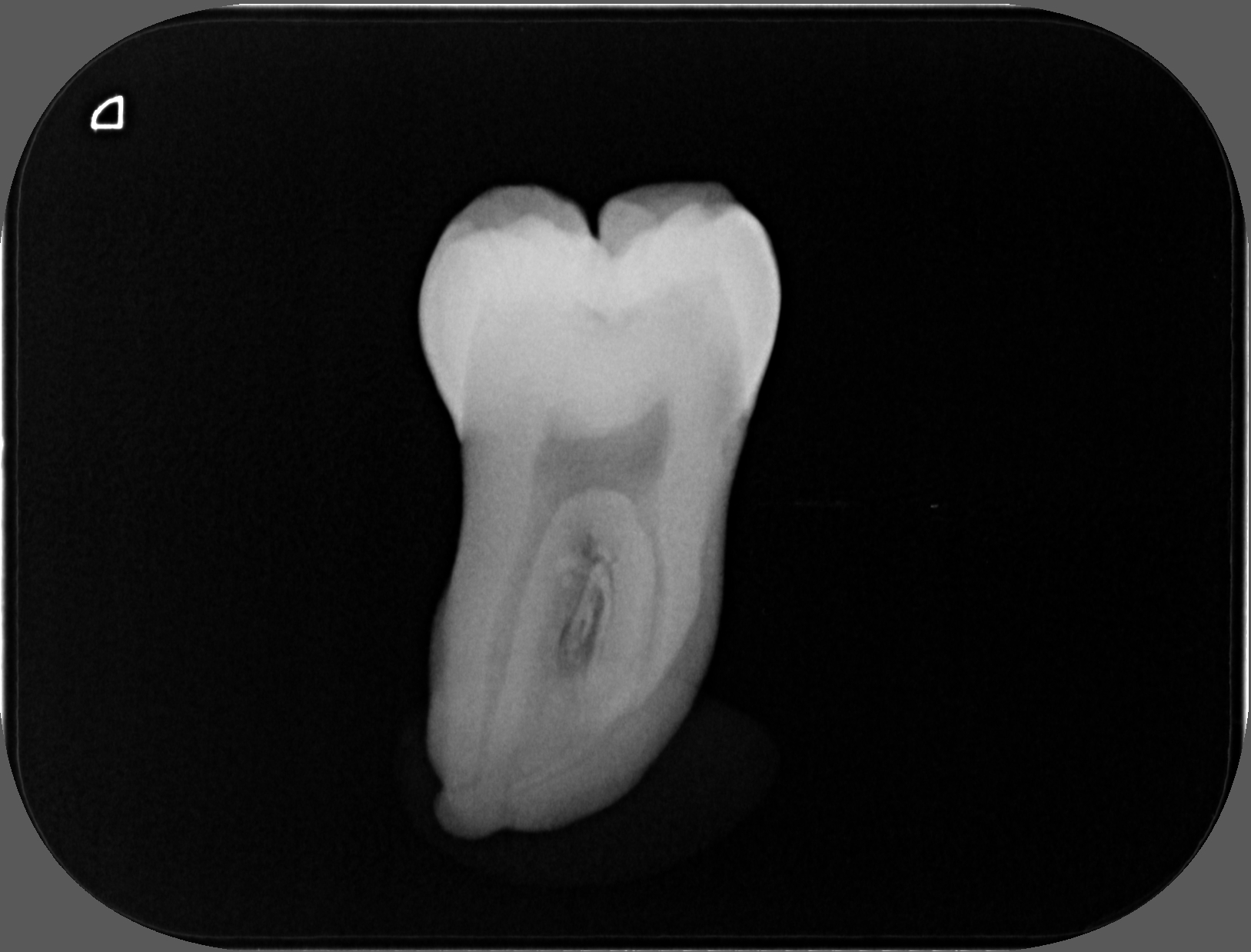 Abb. 7a: Die okklusale Dentinkaries ist im Röntgenbild ...