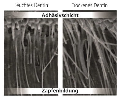 REM-Aufnahme (1‘000-fache Vergrößerung) der Dentintubuli nach Applikation von Adhese Universal.
Lopes M, Universität Lissabon, Portugal, 2013