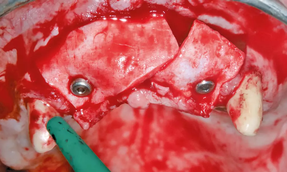 Abb. 10: Intraoperativ erfolgte die Fixierung der Matrices mit konfektionierten Gingivaformern und Umschlingungsnähten.