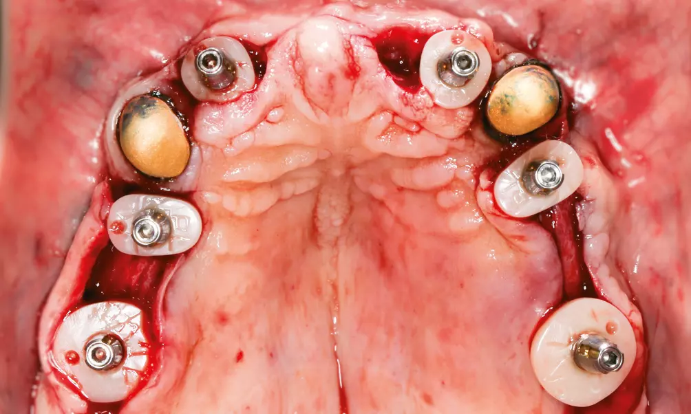 Abb. 15: Nach der Implantatfreilegung in Kombination mit einer dezenten Verschiebeplastik erfolgte die Abformung mit individualisierten Abform-Abutments (Cervico-System).