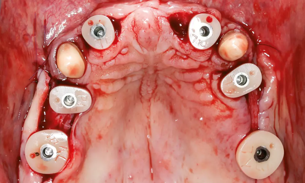 Abb. 16: Nach Entfernung der Abformpfosten erfolgte die Insertion formkongruenter individualisierter Healing Abutments.