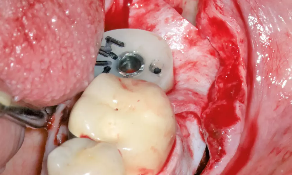 Abb. 3: Simultan zur Implantation erfolgte die Transplantation der Matrix, die mithilfe eines individuellen Gingivaformers und Umschlingungsnähten fixiert wurde.