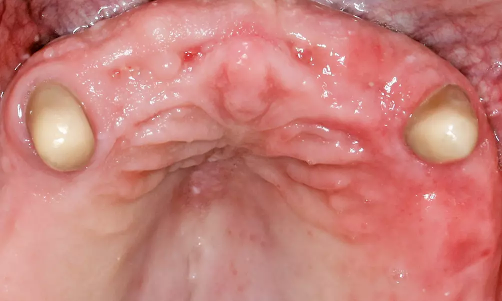 Abb. 9: Nach Ridge Preservation mit autogenem Dentin in der Oberkieferfront imponierte ein ausreichend dimensioniertes knöchernes Lager für eine Spätimplantation.