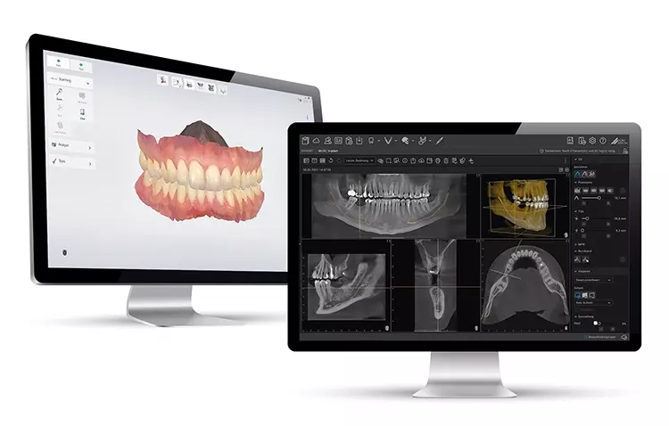 Nahtloser Workflow von 3ShapeUnite (li.) zu VistaSoft von DÜRR DENTAL.