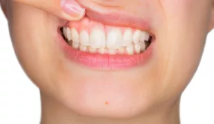 Die neue Klassifikation parodontaler und periimplantärer Erkrankungen und Zustände soll eine weltweit einheitliche Vorgehensweise zu Diagnostik und Handhabung ermöglichen. (Symbolfoto).