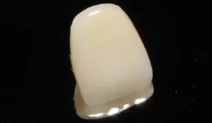Lithiumdisilikatkrone nach der Politur.