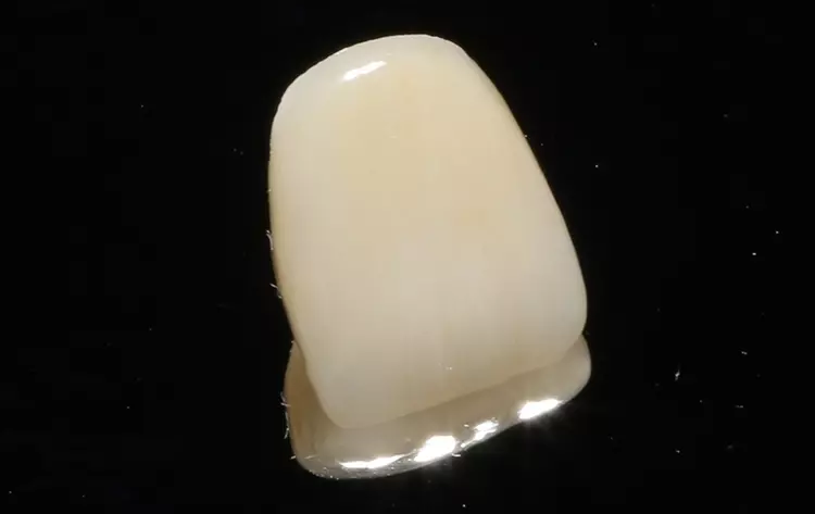 Lithiumdisilikatkrone nach der Politur.