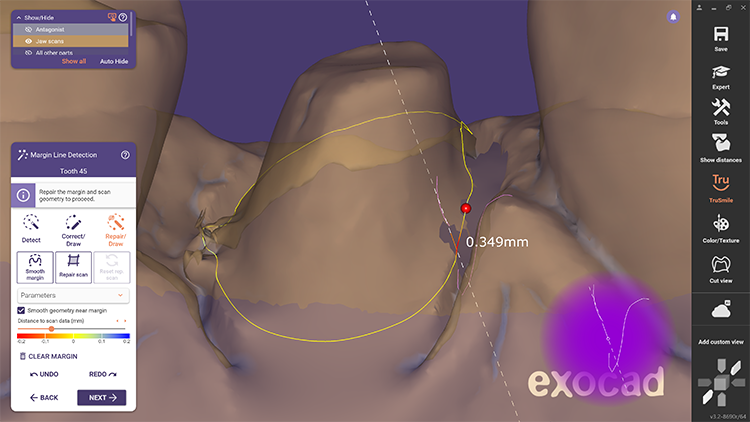 Das neue Tool zur Reparatur von Präparationslinien erlaubt es Anwendern, trotz Artefakten oder Löchern im Scan ein akzeptables Ergebnis zu erhalten.