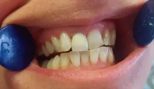 Effektives Biofilmmanagement: Prophylaxe in der Praxis und im Rahmen der häuslichen Mundhygiene zahlen sich aus.